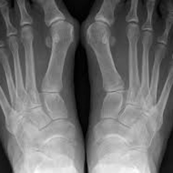 Так выглядит проблема на рентгеновских снимках.