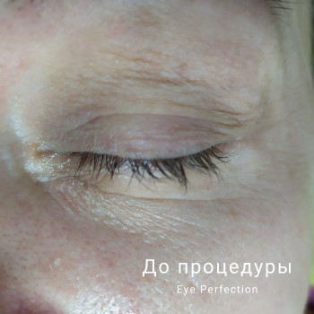 До процедуры Eye Perfection