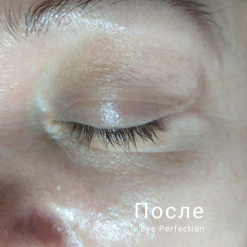 После 1 процедуры Eye Perfection