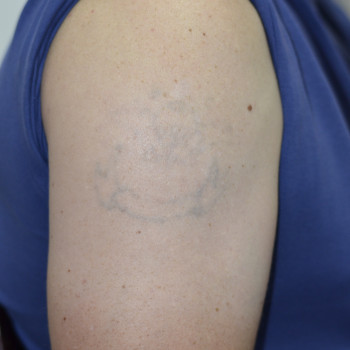 Видалення тату та татуажу
                    Тату мастер Сергей Педченко Кривой Рог