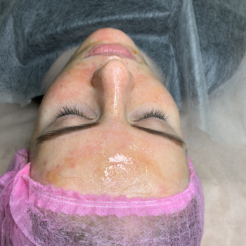 Карбоксітерапія