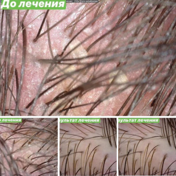 Лечение перхоти и себорейного дерматита
                    Дерматолог косметолог Алёна Николаев