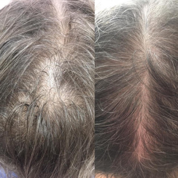 Лечение выпадения волос
                    Дерматолог косметолог Алёна Николаев