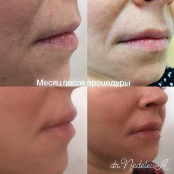 Контурная пластика губ
                    Дерматолог косметолог Алёна Николаев