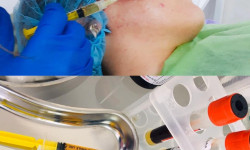 Плазмотерапия (PRP) Дерматолог косметолог Алёна Николаев