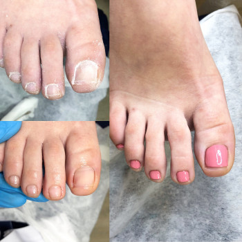 Медицинский педикюр
                    Подолог Ольга Черная Запорожье