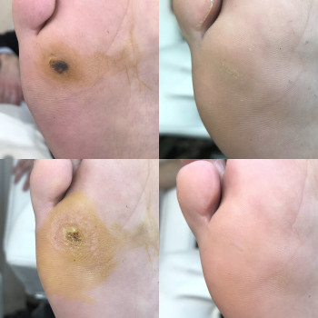 Медицинский педикюр
                    Подолог Ольга Черная Запорожье