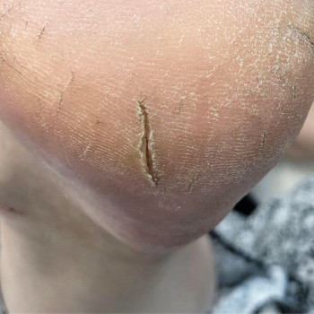 Медицинский педикюр
                    Подолог Ольга Черная Запорожье