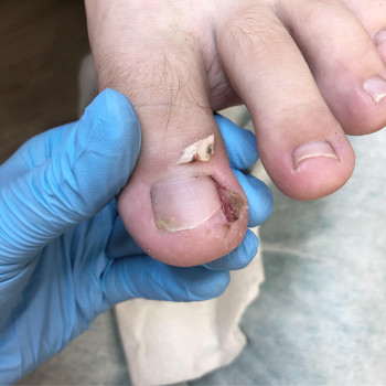 Медицинский педикюр
                    Подолог Ольга Черная Запорожье