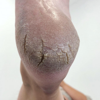 Медицинский педикюр
                    Подолог Ольга Черная Запорожье