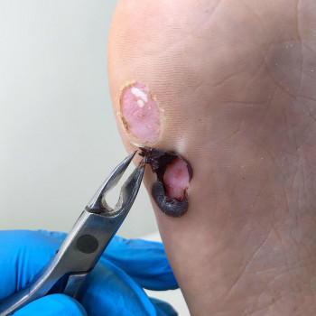 Медицинский педикюр
                    Подолог Ольга Черная Запорожье