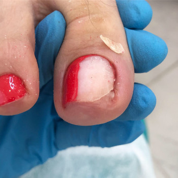 Медицинский педикюр
                    Подолог Ольга Черная Запорожье