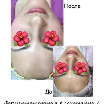 Ферментотерапия в сочетании с травяным пилингом