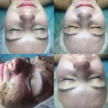 Процесс чистки лица. Комбинирование термо-пилинга с травяным