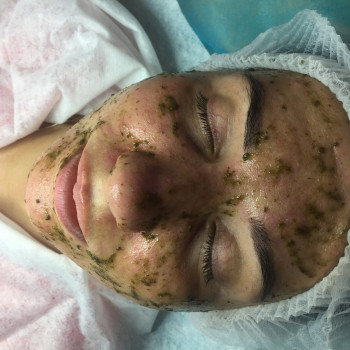 Травяной пилинг