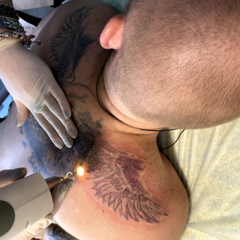 Выведение татуировок и татуажа