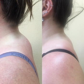 Работа с вдовьим горбом
Устранение массажем