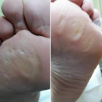 Обработка натоптышей