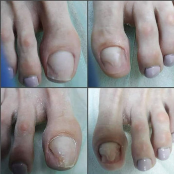 Протезирование ногтевой пластины