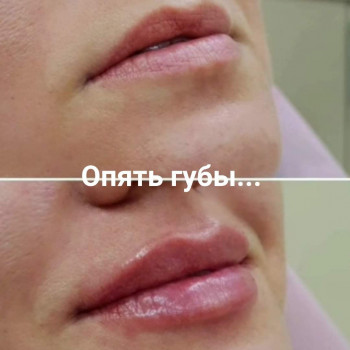 Филлер 0.5мл 
Акция в июне 2000 грн