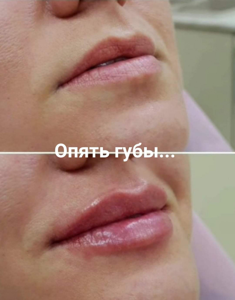 Филлер 0.5мл 
Акция в июне 2000 грн, фото -  