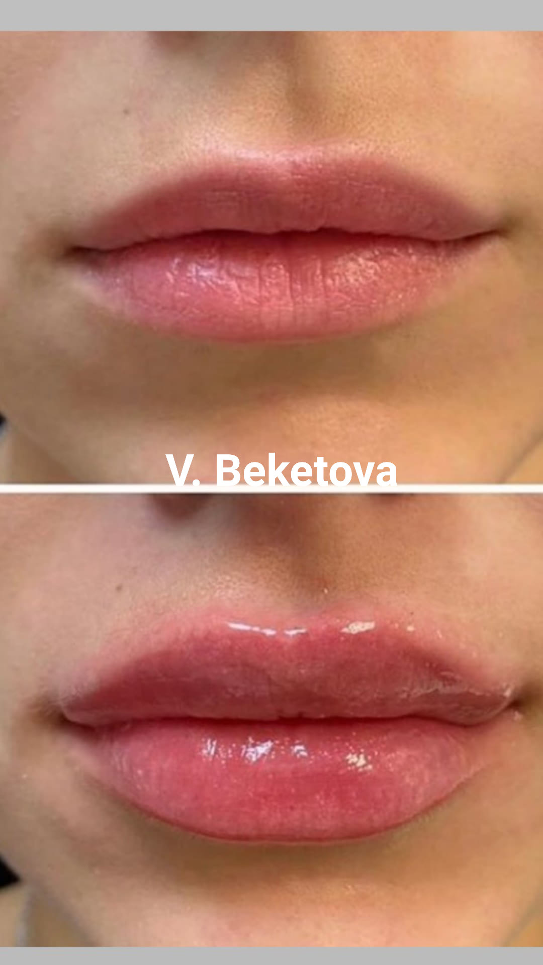 Juvederm 1 ml 3600 грн, фото - Косметолог Виктория Бекетова Бекетова