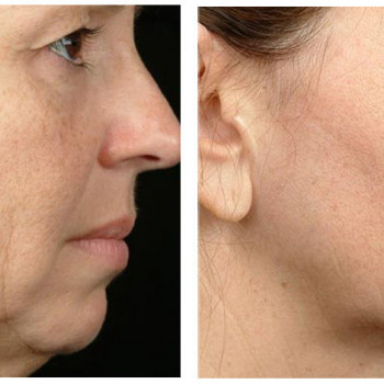 RF-лифтинг
                    Косметологический центр Корпорация красоты (косметология) Киев