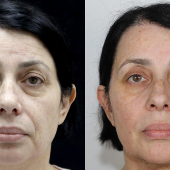 аппаратное омоложение