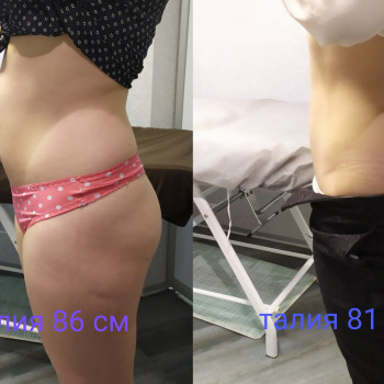 Один сеанс липолитиков