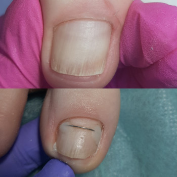 Коррекція врослого нігтя
                    Подолог Татьяна Викторовна Запорожье