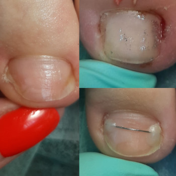 Коррекція врослого нігтя
                    Подолог Татьяна Викторовна Запорожье