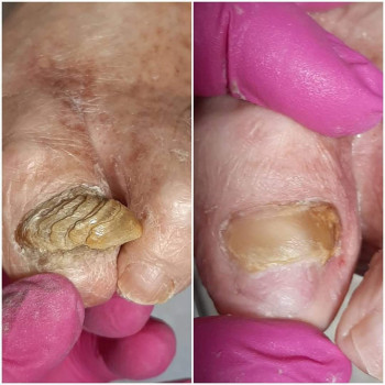 Робота з грибковим нігтем
                    Подолог Татьяна Викторовна Запорожье