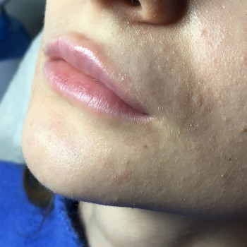 Контурная пластика губ препаратом Stylage S 0,8 ml.