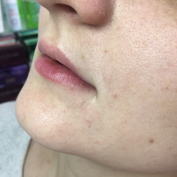 Контурная пластика губ препаратом Stylage S 0,8 ml.