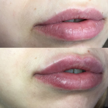 Контурная пластика губ препаратом Juvederm ultra 3 1,0 ml.