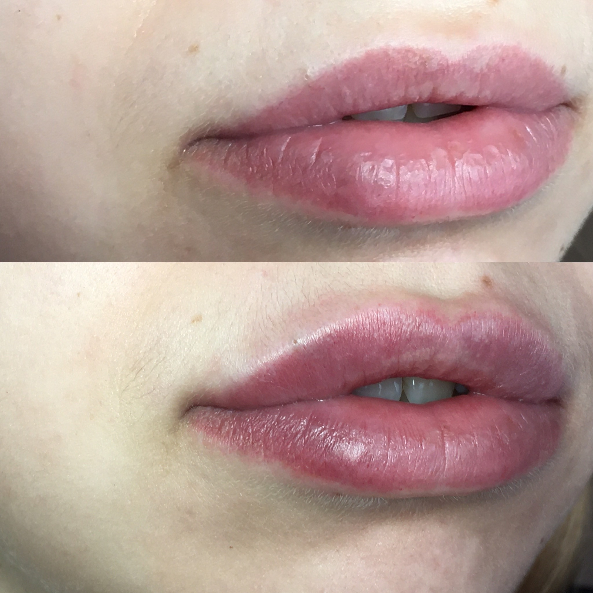 Контурная пластика губ препаратом juvederm ultra 3 1,0 ml., фото - Косметолог Алена Птуха