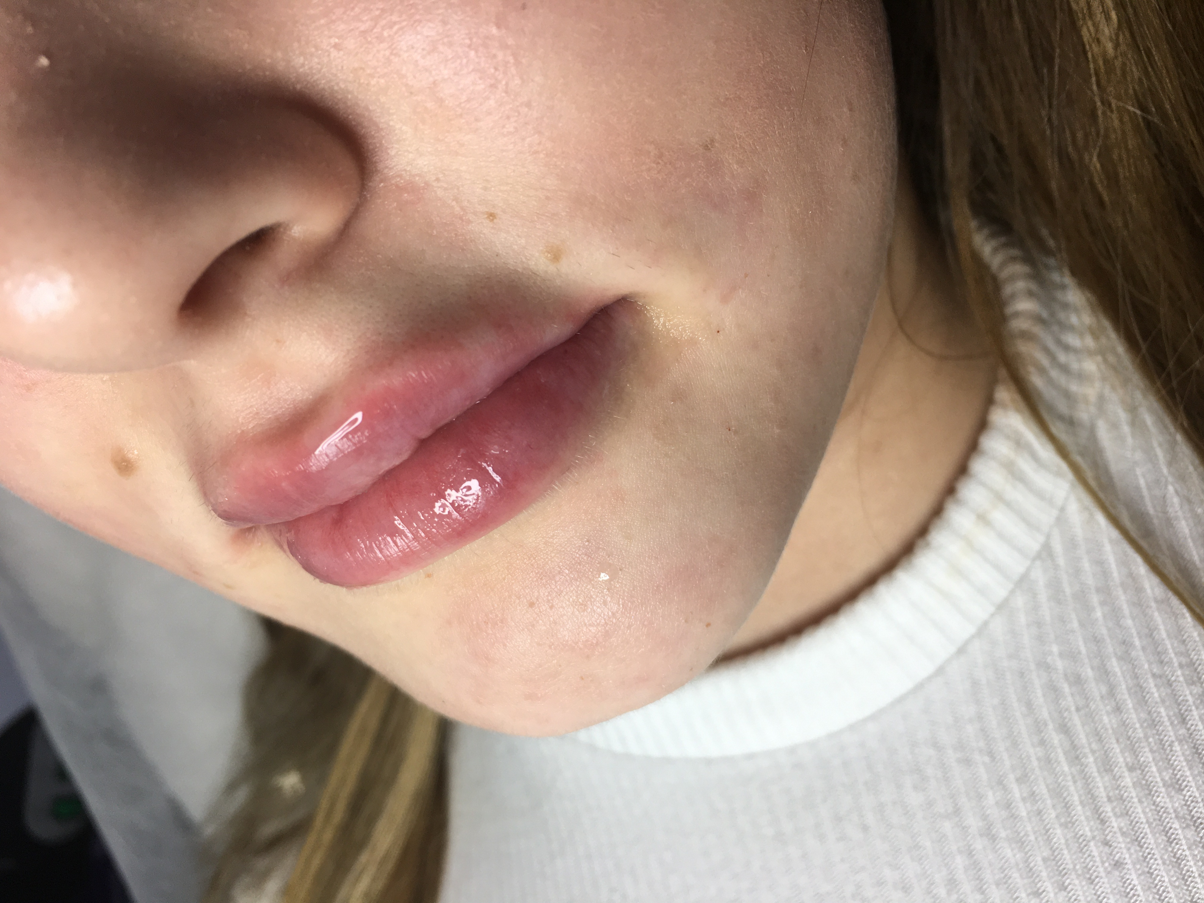 Контурная пластика губ препаратом juvederm ultra 3 1,0 ml., фото - Косметолог Алена Птуха