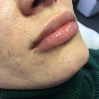 Контурная пластика губ препаратом Juvederm ultra 3 1,0 ml.