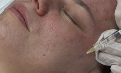 Мезотерапия лица 2,0 мл (Vitamin complex) Испания Врач-косметолог Екатерина Киев