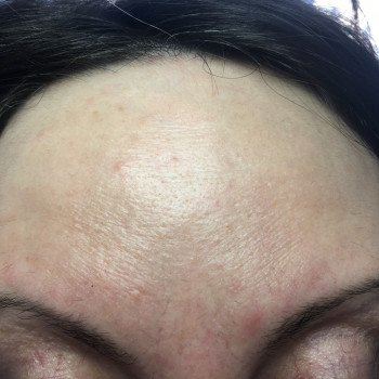 Ботулинотерапия области лба. Фото сделано во время максималь