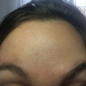 Ботулинотерапия области лба. Фото сделано во время максималь