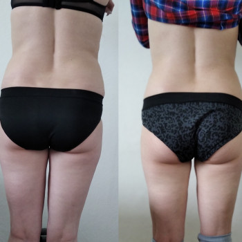 Коррекция фигуры 7 сеансов.