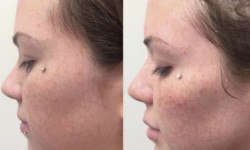Face Nade 2,5мл (липолитик для лица) Испания Лікар-косметолог Екатерина Київ