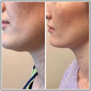 После двух процедур липолитика