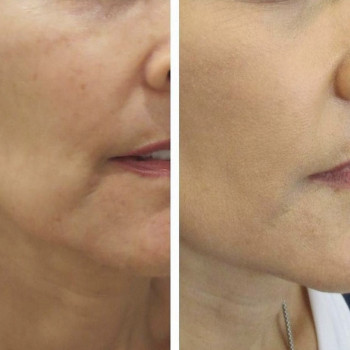 Restylane Vital Light 1,0 (Рестилайн), биоревитализация и скинбустер, Швеция
                    Врач-косметолог Екатерина Киев