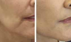 Restylane Vital Light 1,0 (Рестилайн), биоревитализация и скинбустер, Швеция Лікар-косметолог Екатерина Київ