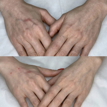 Restylane Vital Light 1,0 (Рестилайн), биоревитализация и скинбустер, Швеция
                    Врач-косметолог Екатерина Киев