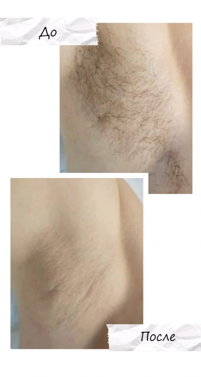 Воскова депіляція зони пахвових западин, фото -  