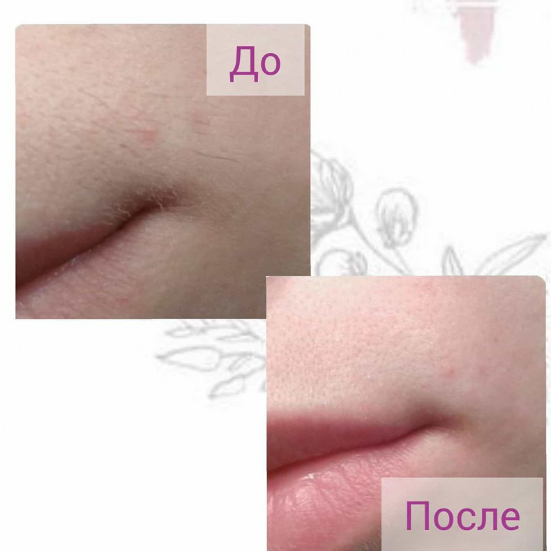 Воскова депіляція зони вусики, фото -  