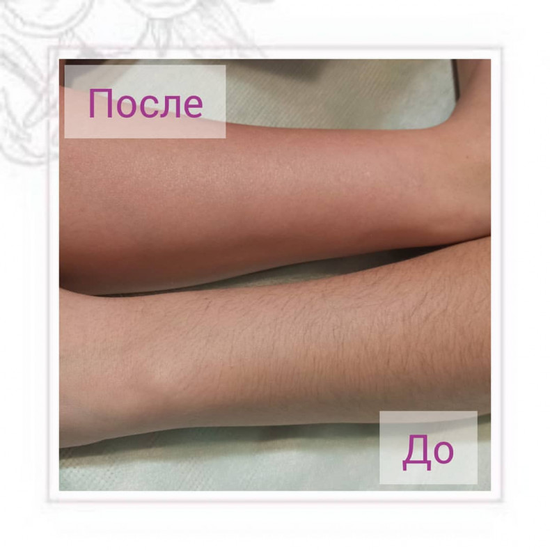 Воскова депіляція зони ручки до ліктя, фото -  